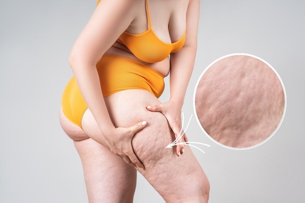Lipedema — diagnóstico tardio